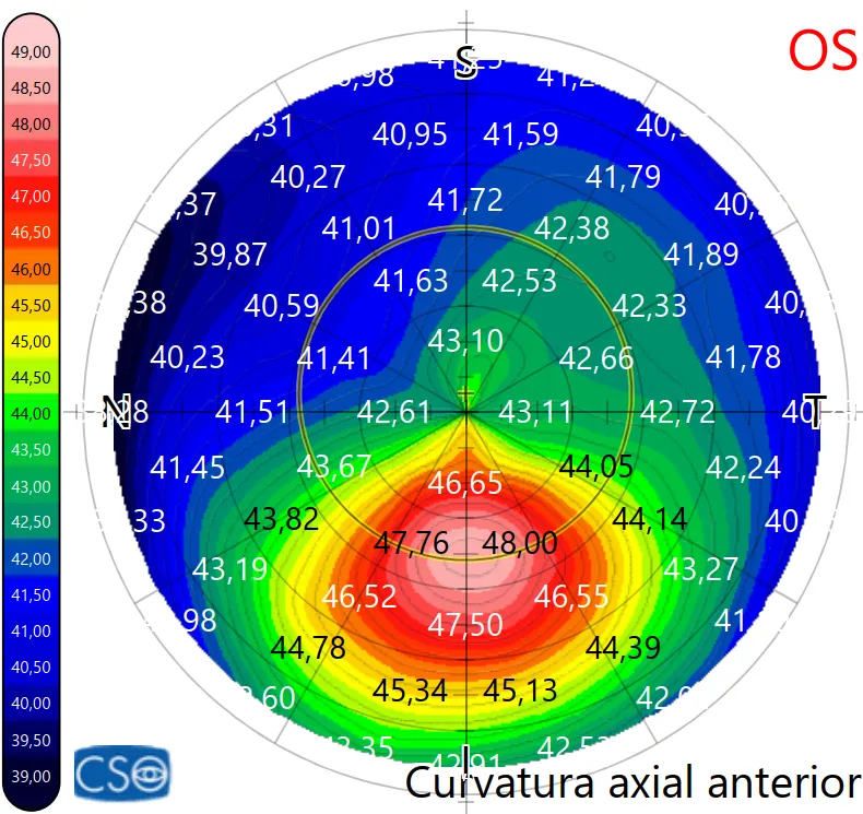 Topografia de córnea mostrando o mapa de curvatura axial anterior com padrão típico de ceratocone